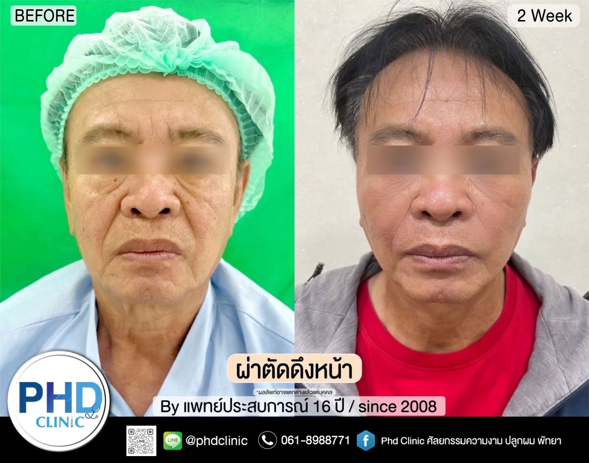 Rhytidectomy Pattaya