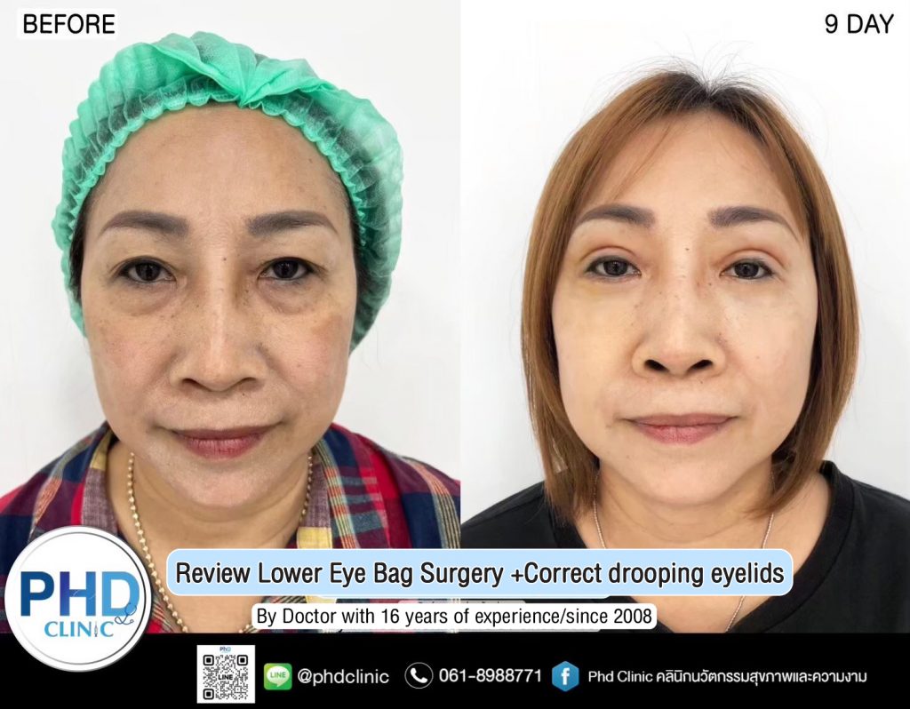 Lower Eye Bag Surgery Pattaya