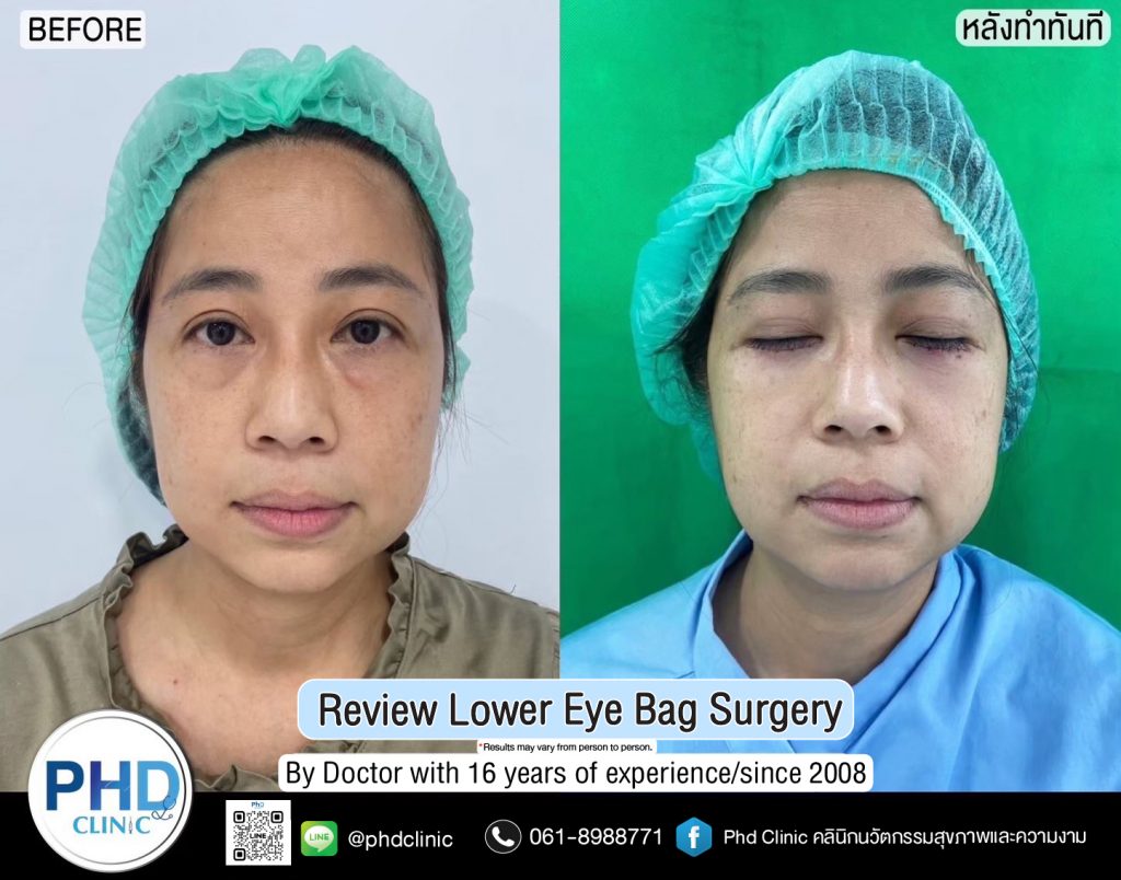 Lower Eye Bag Surgery Pattaya