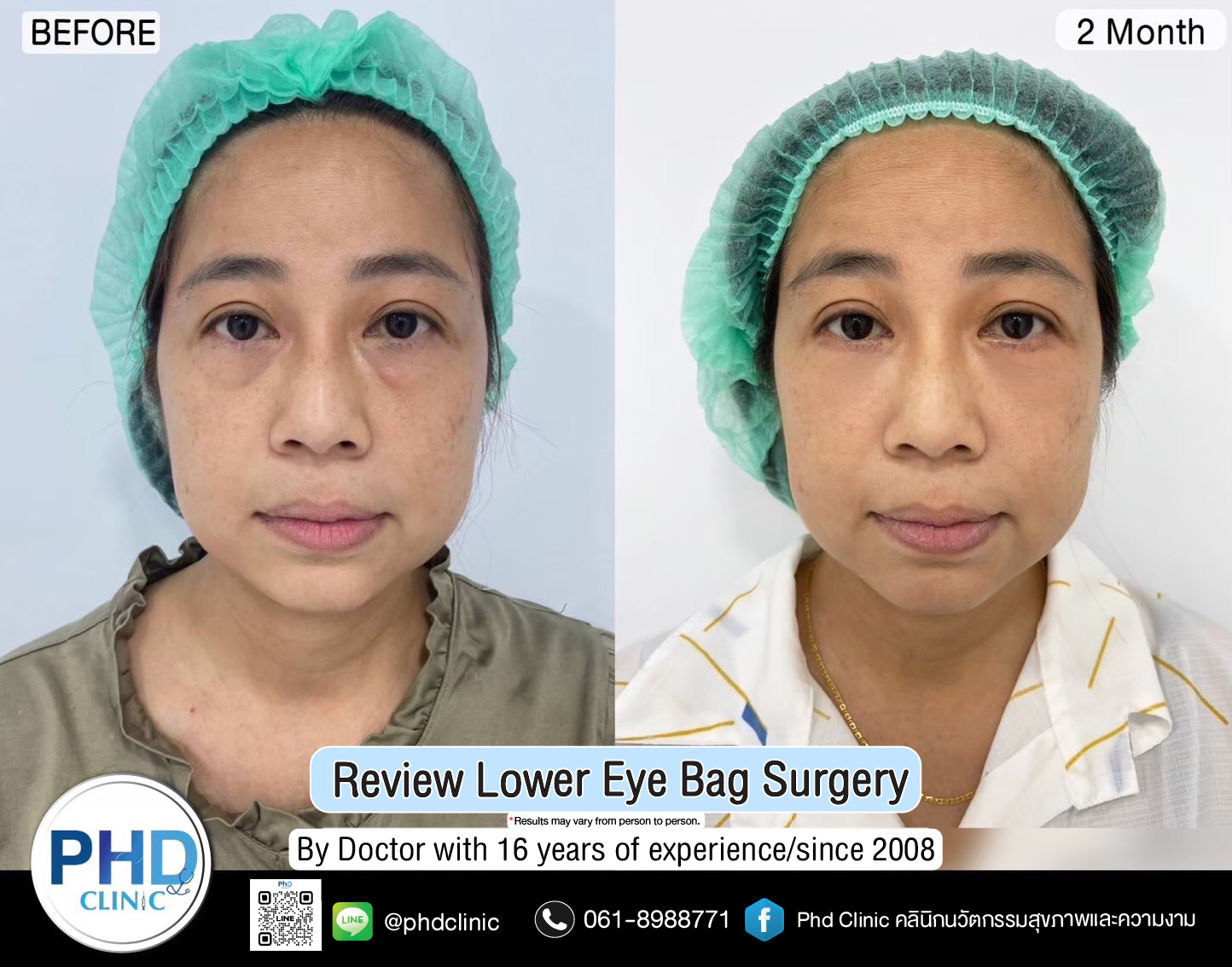 Lower Eye Bag Surgery Pattaya