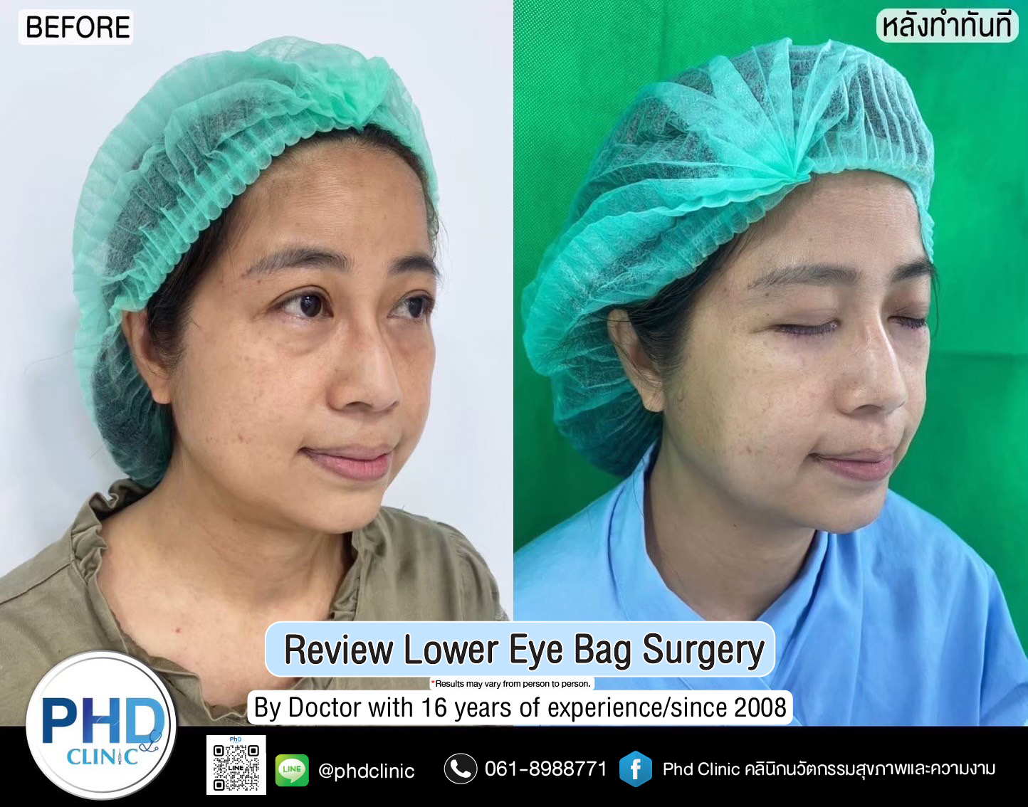 Lower Eye Bag Surgery Pattaya