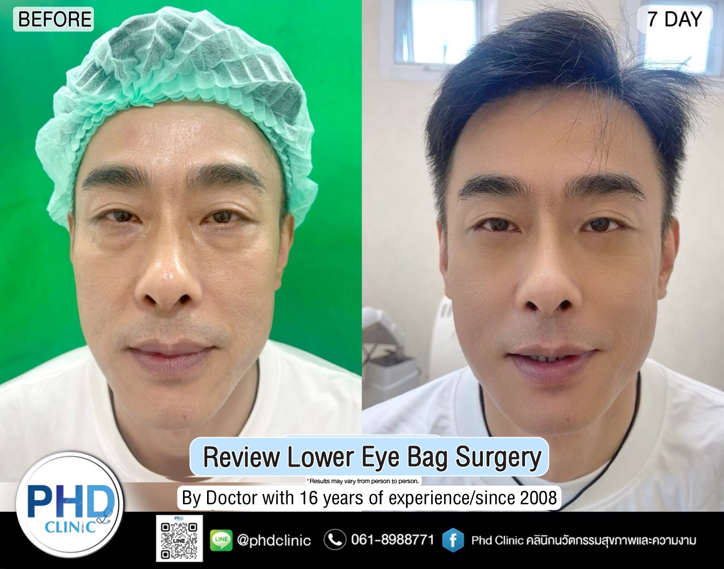 Lower Eye Bag Surgery Pattaya