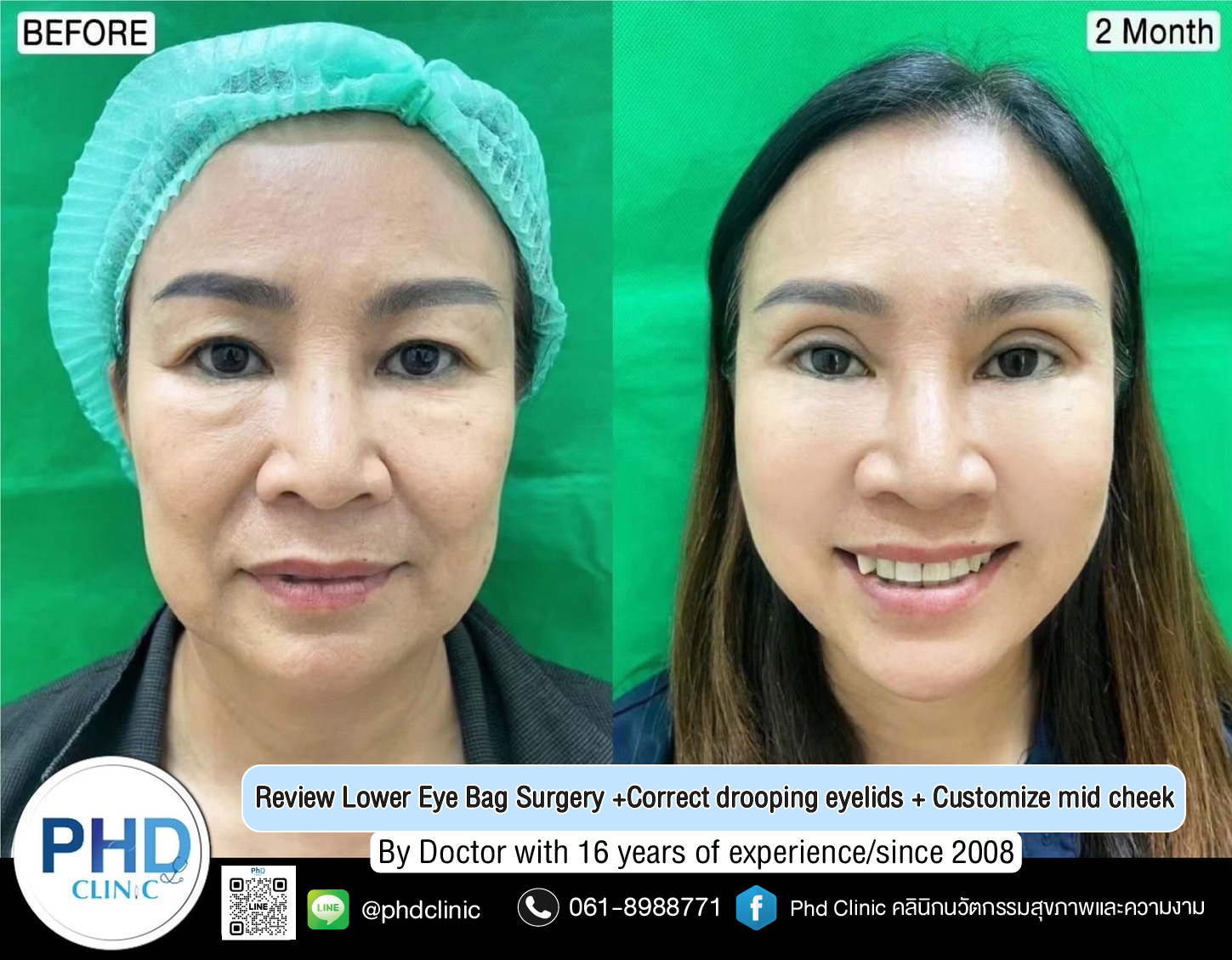 Lower Eye Bag Surgery Pattaya