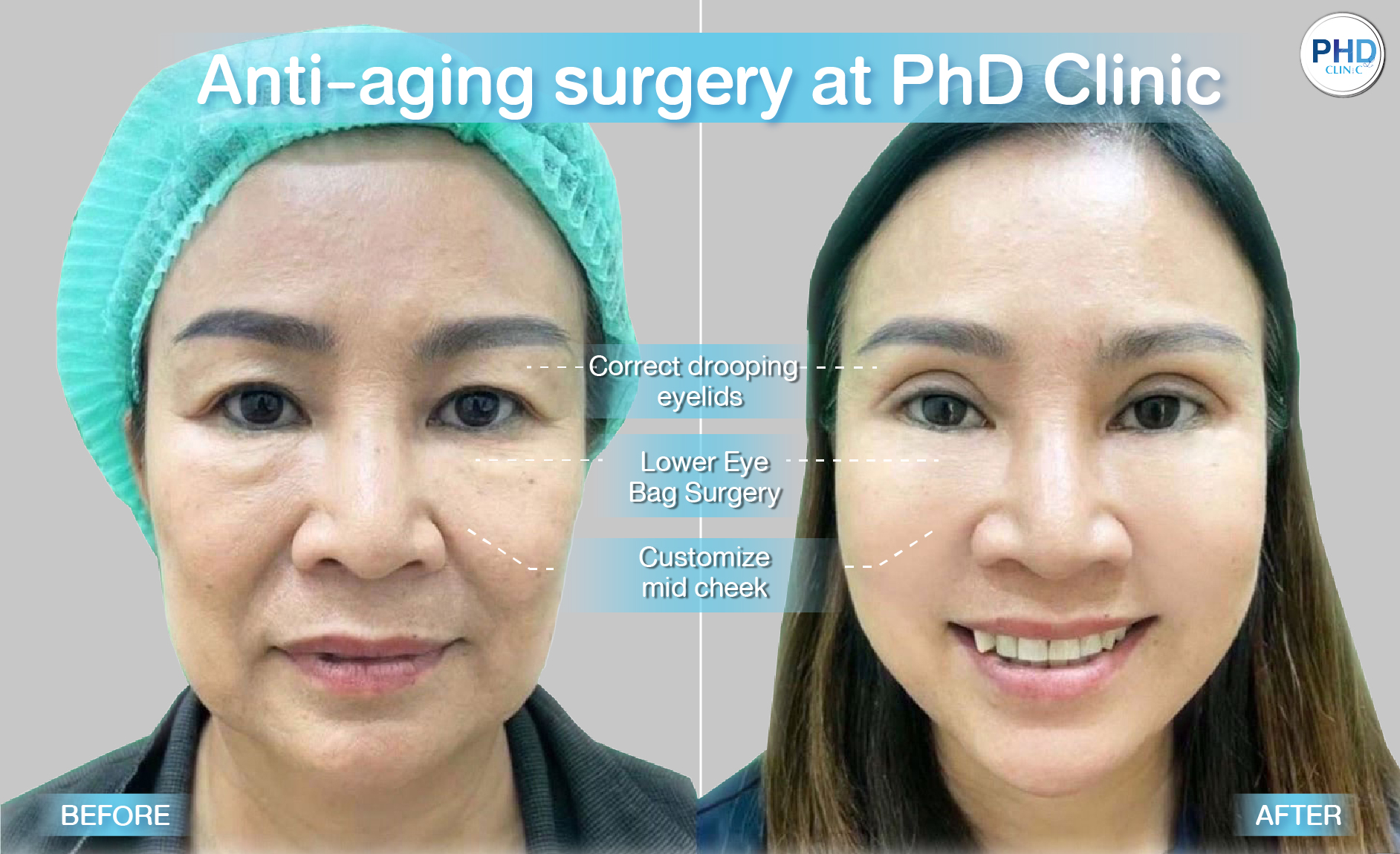 Lower Eye Bag Surgery Pattaya