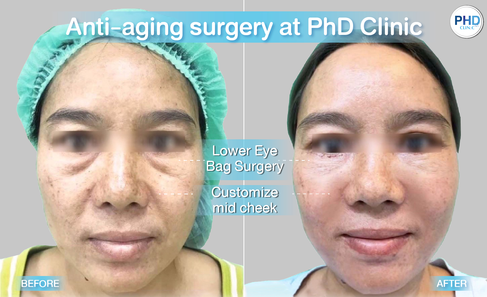 Lower Eye Bag Surgery Pattaya