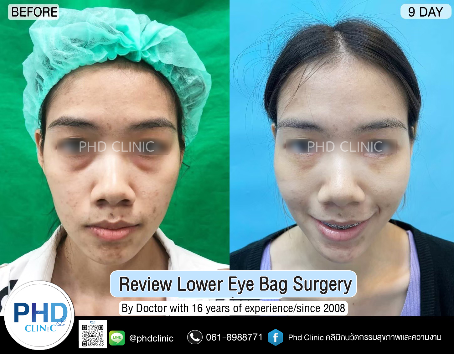 Lower Eye Bag Surgery Pattaya