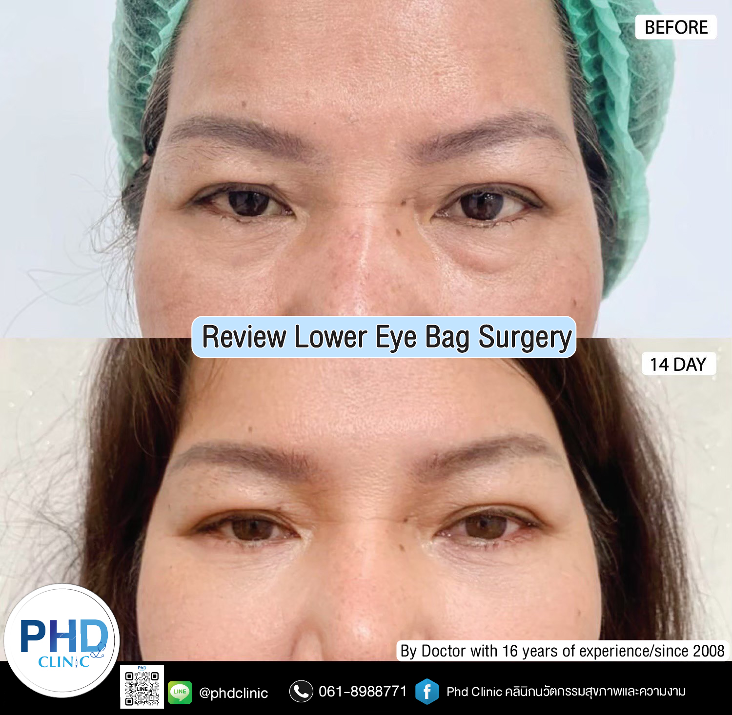 Lower Eye Bag Surgery Pattaya