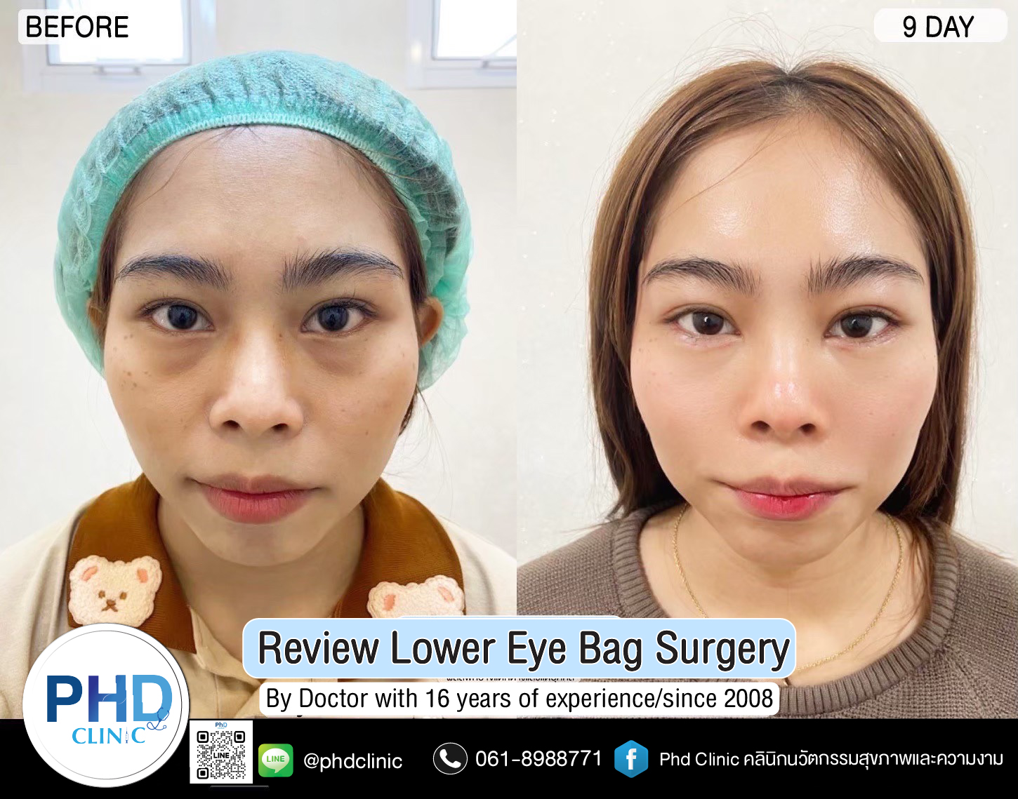 Lower Eye Bag Surgery Pattaya