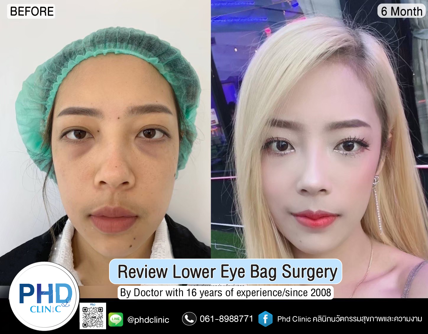 Lower Eye Bag Surgery Pattaya