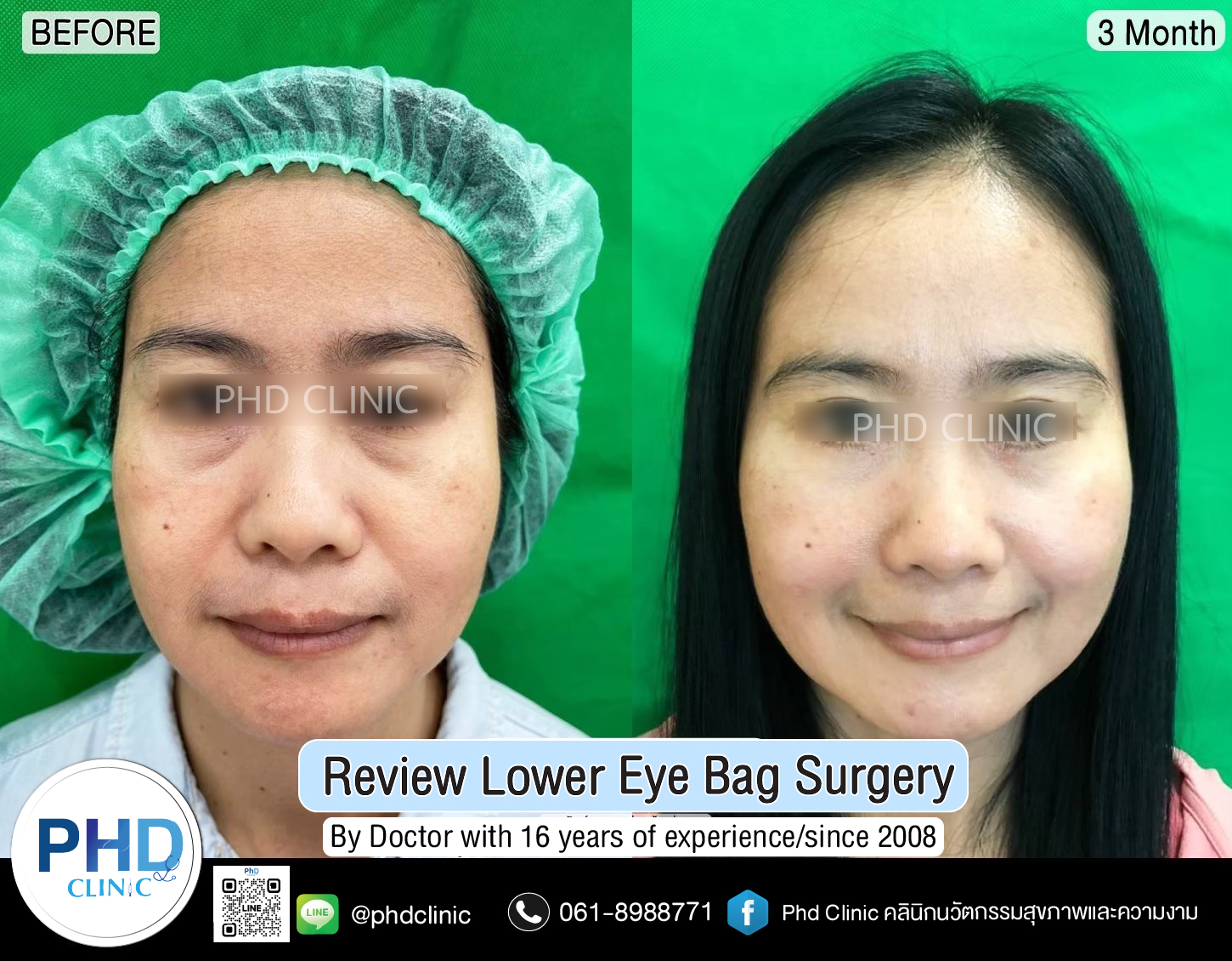 Lower Eye Bag Surgery Pattaya