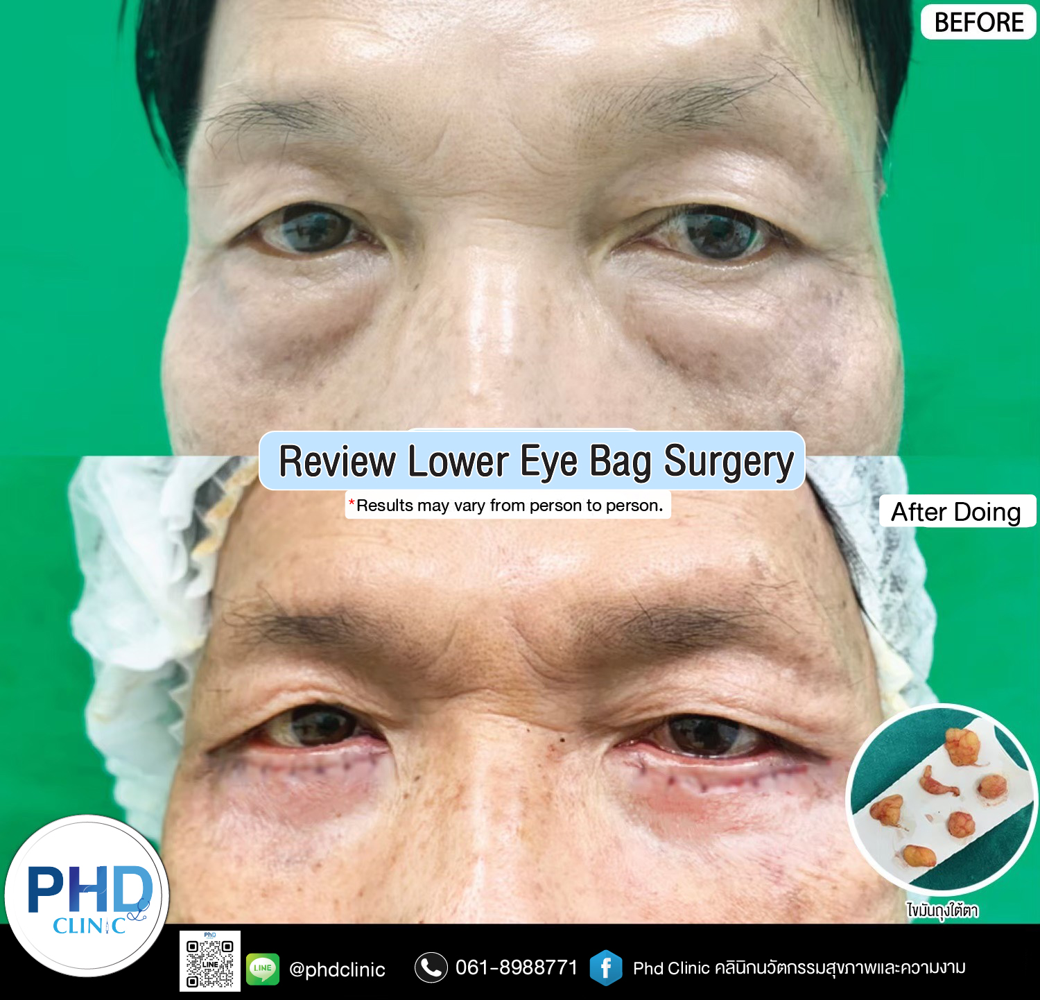 Lower Eye Bag Surgery Pattaya