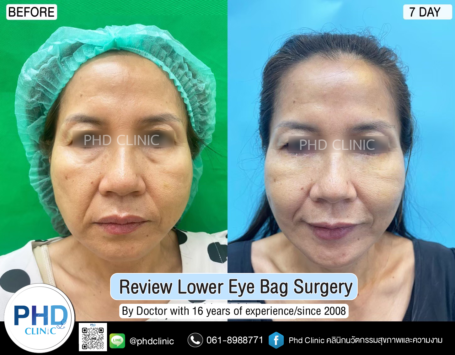 Lower Eye Bag Surgery Pattaya