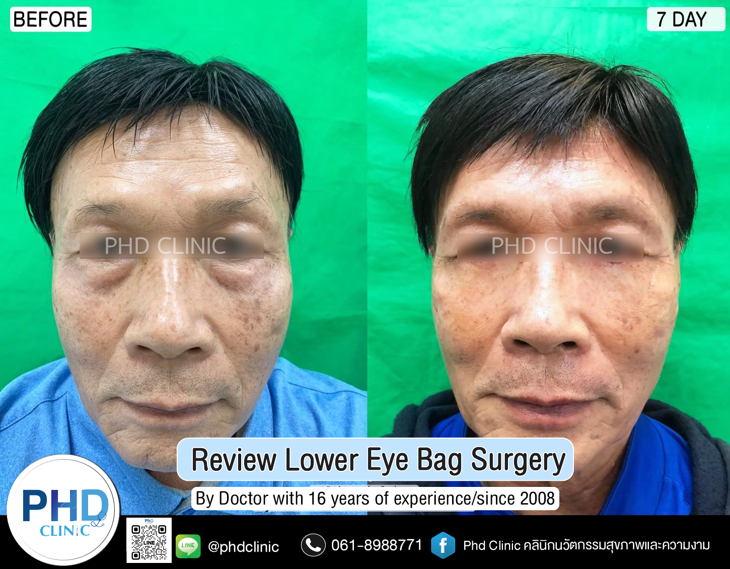 Lower Eye Bag Surgery Pattaya