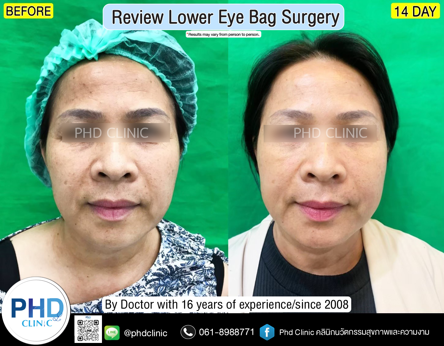 Lower Eye Bag Surgery Pattaya