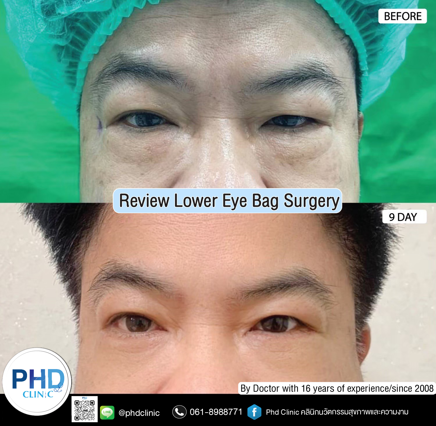 Lower Eye Bag Surgery Pattaya