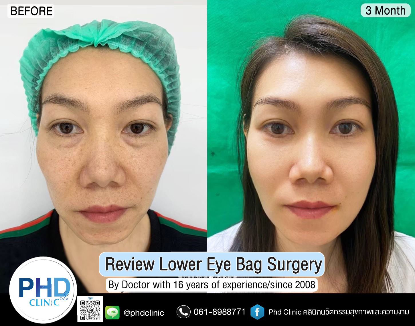 Lower Eye Bag Surgery Pattaya