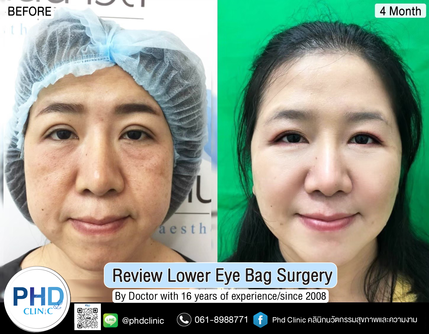 Lower Eye Bag Surgery Pattaya