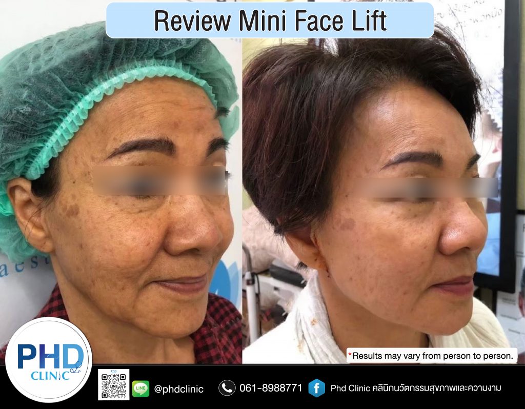 mini face lift