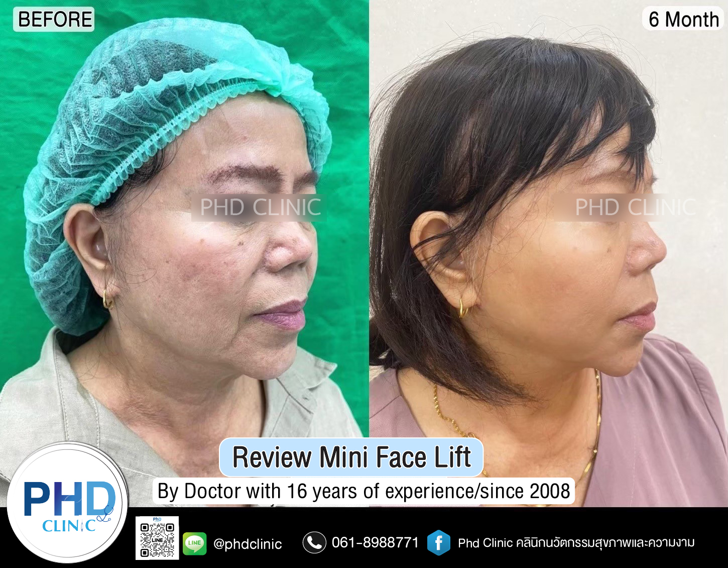 mini face lift