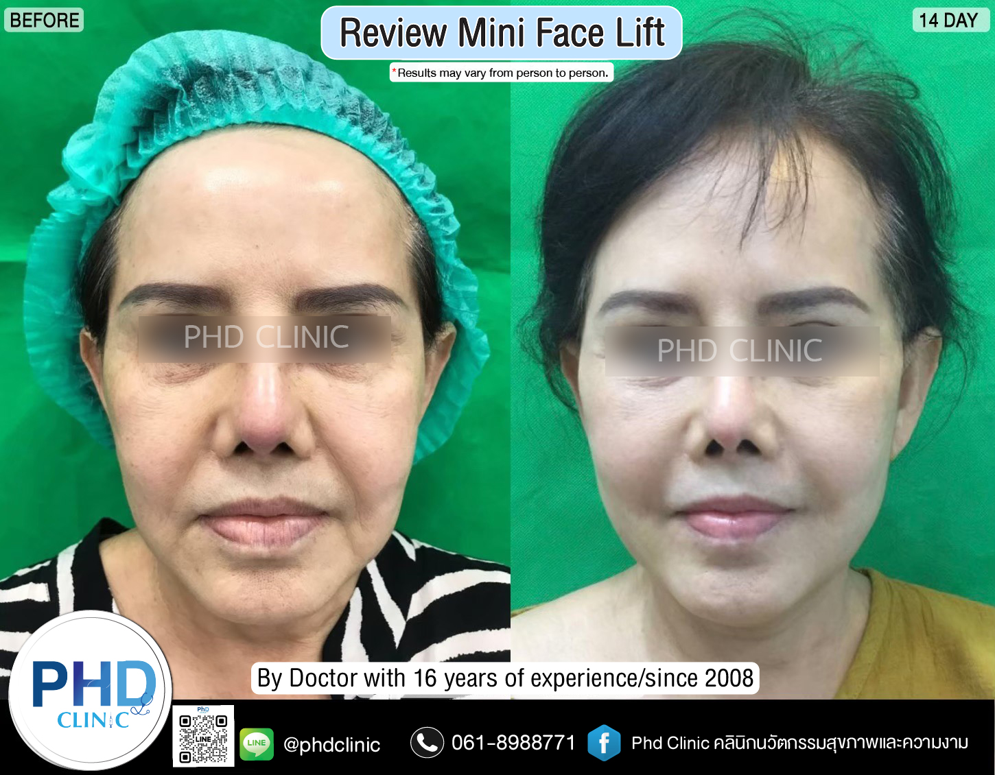 mini face lift