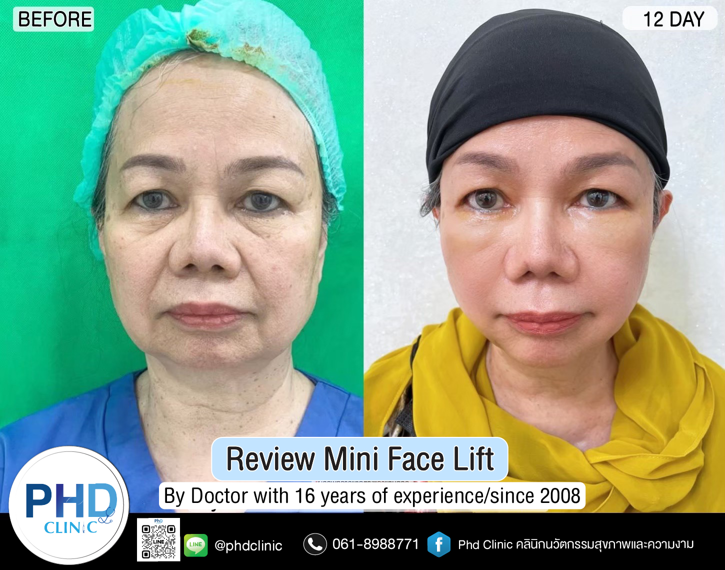 mini face lift