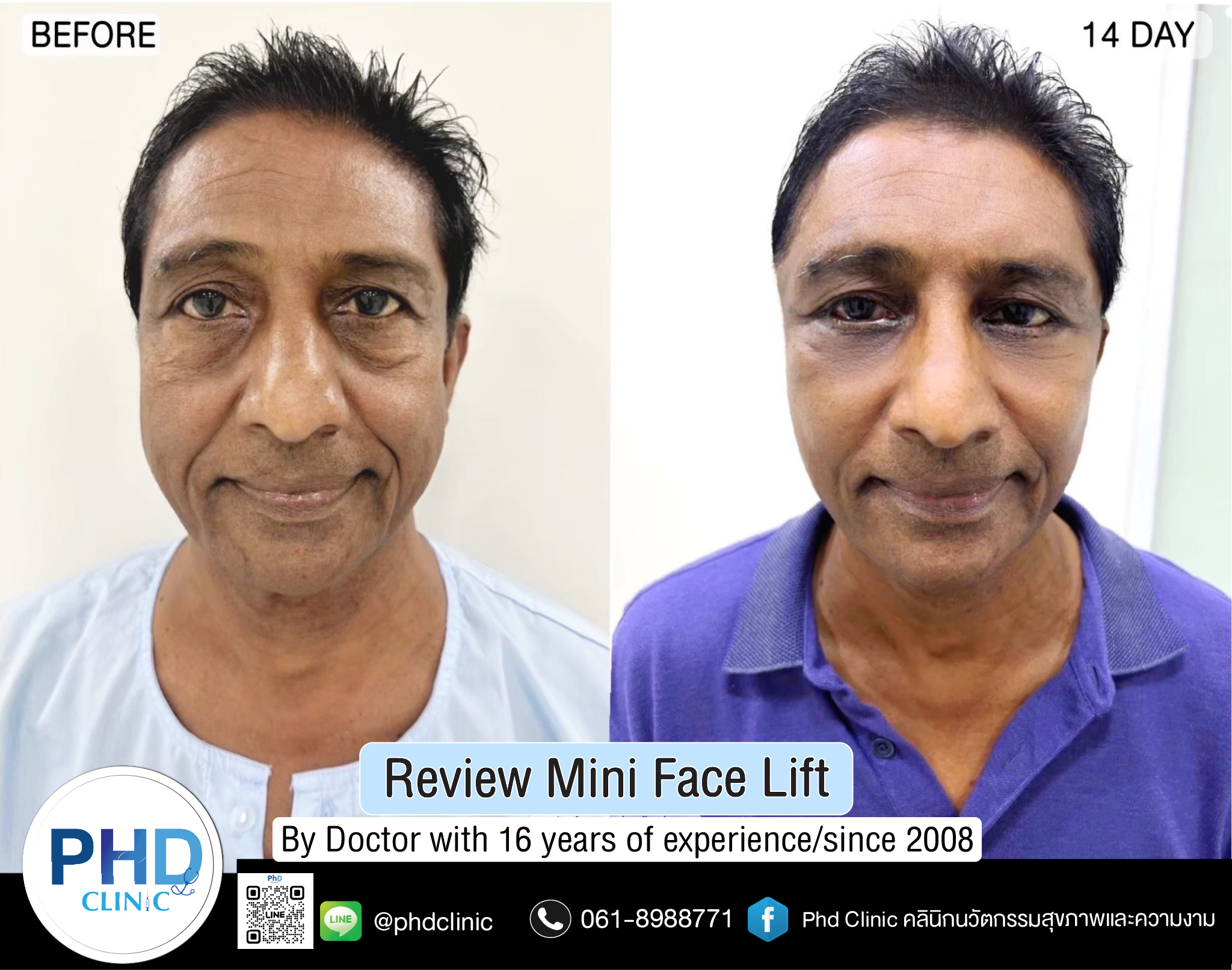 mini face lift