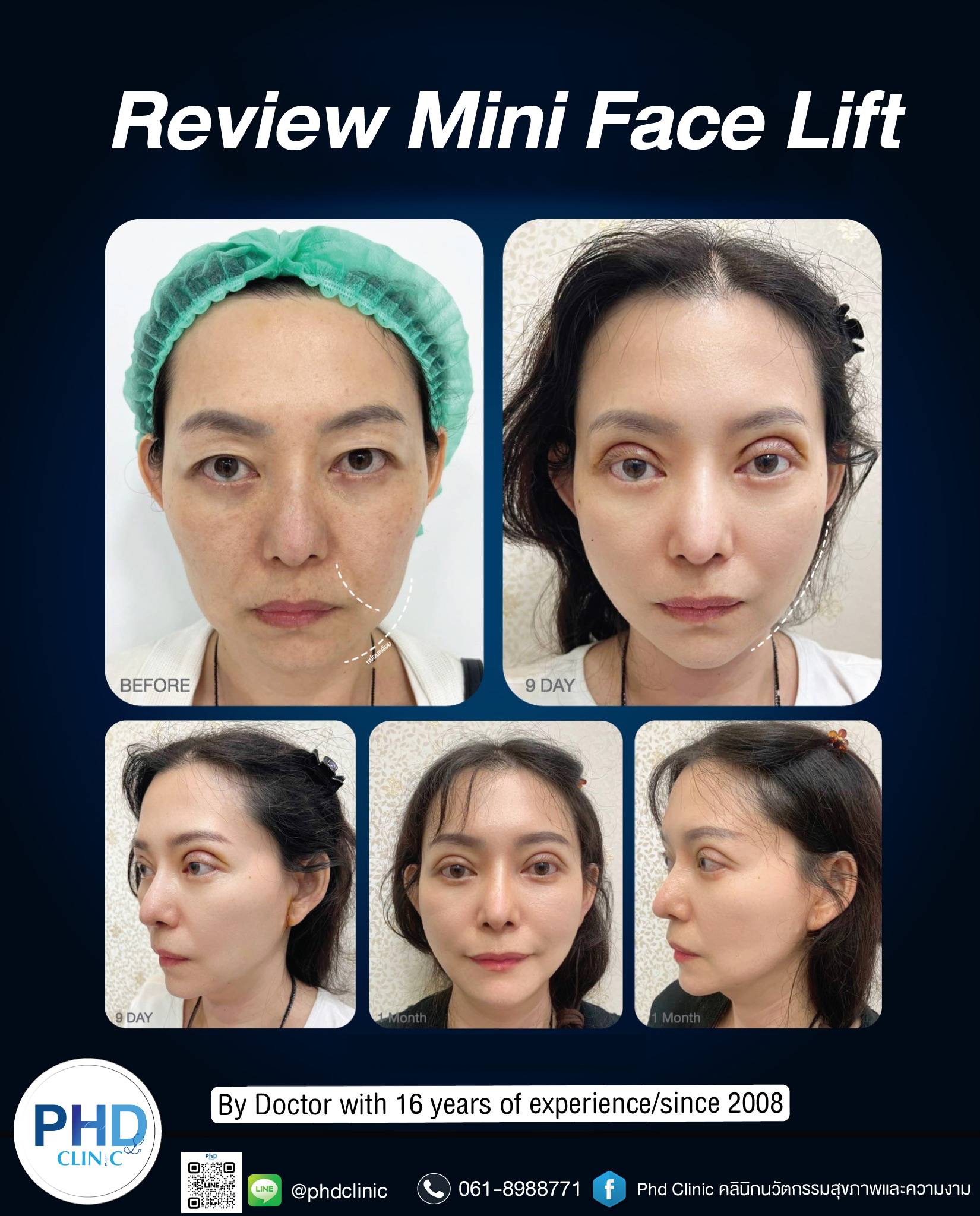 mini face lift