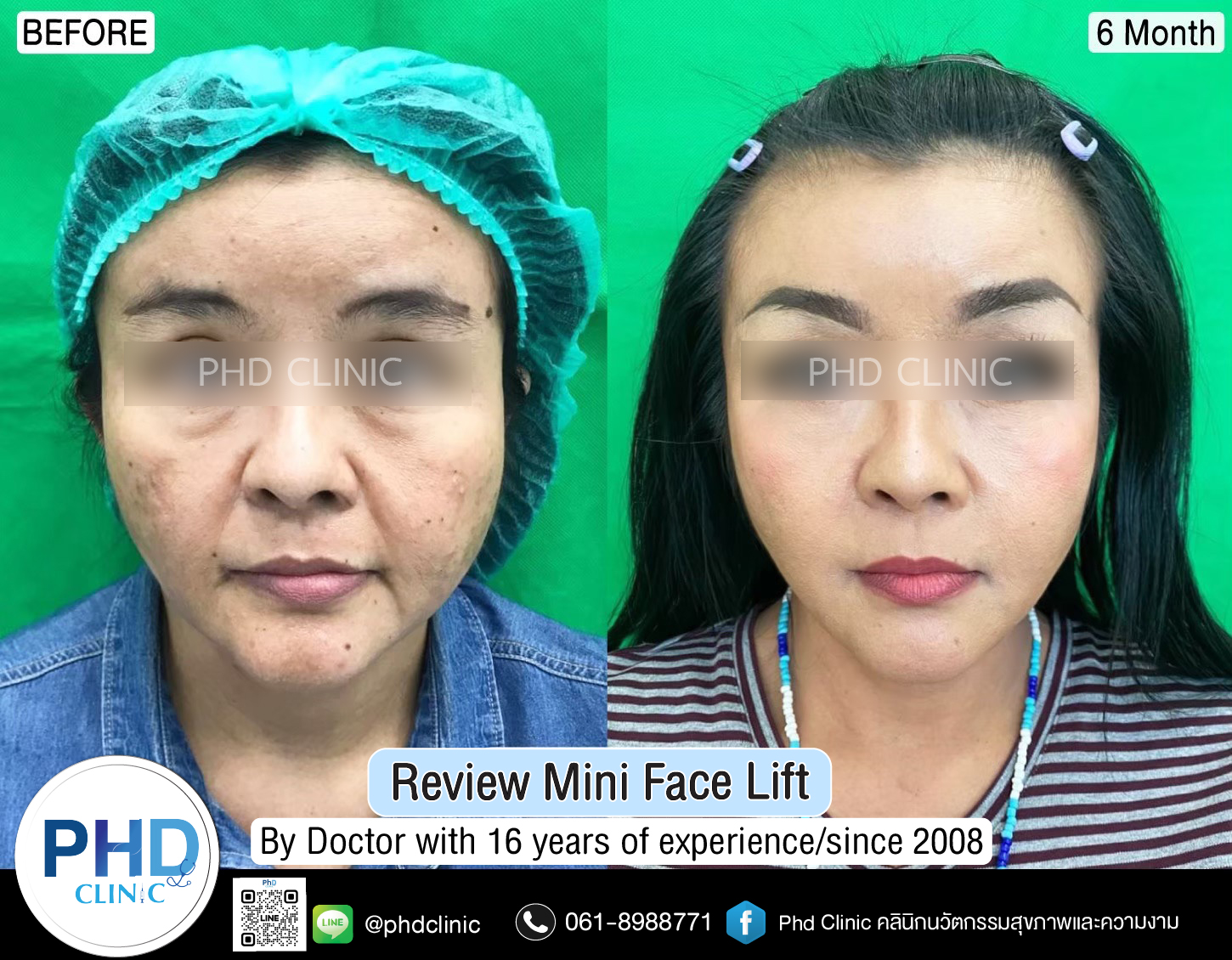 mini face lift