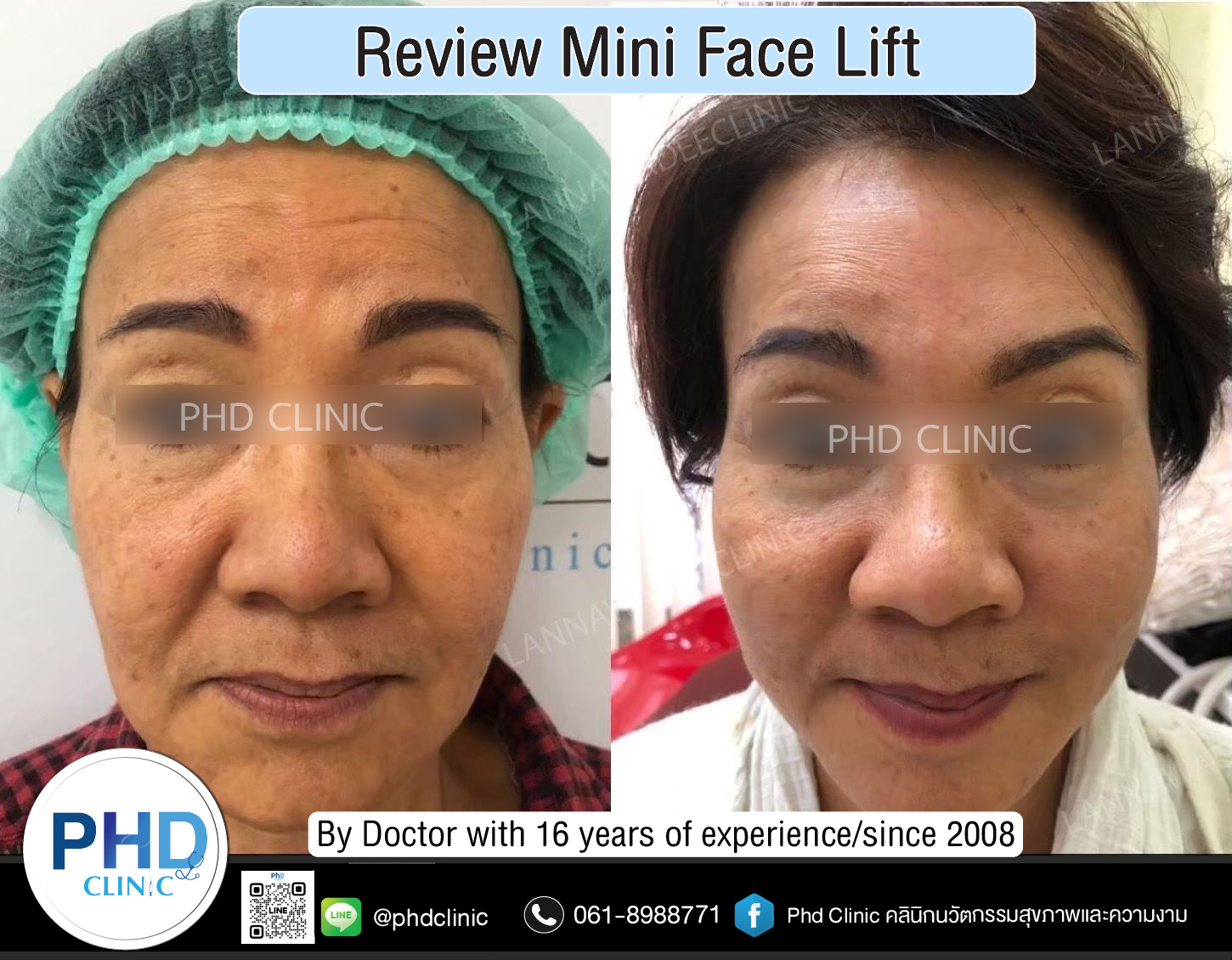 mini face lift