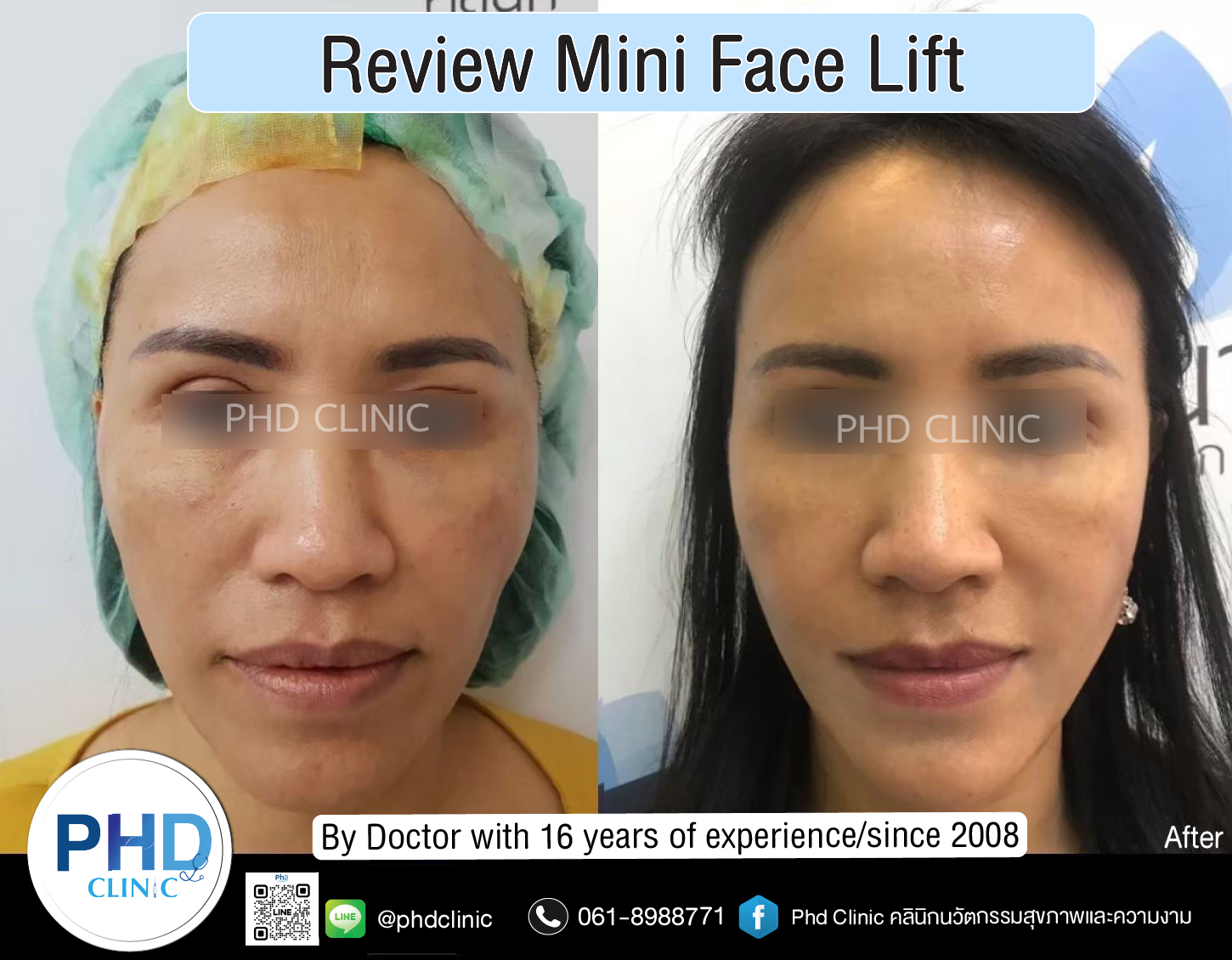 mini face lift