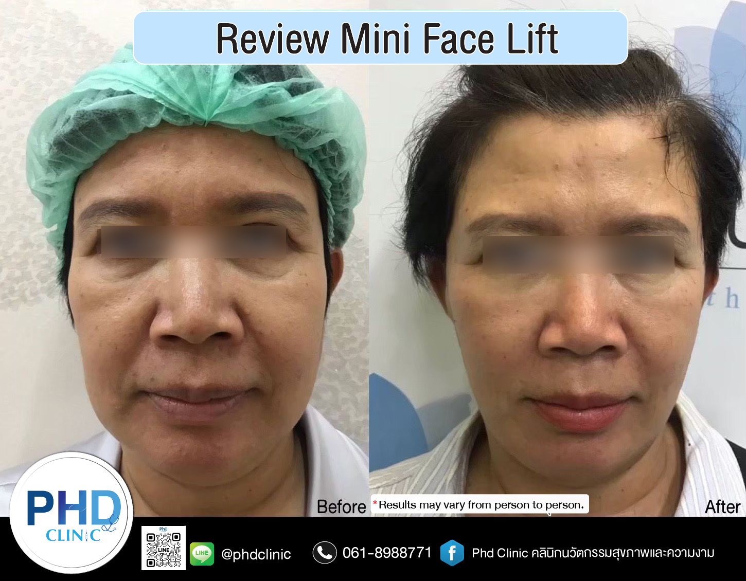 mini face lift