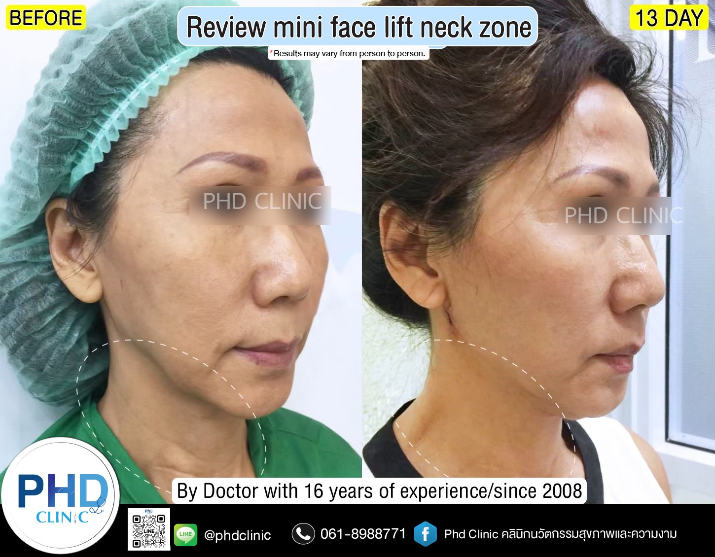 mini face lift