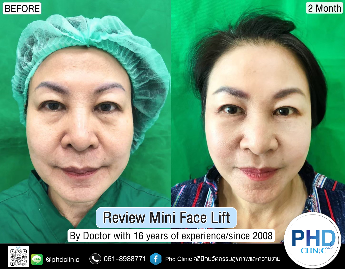 mini face lift