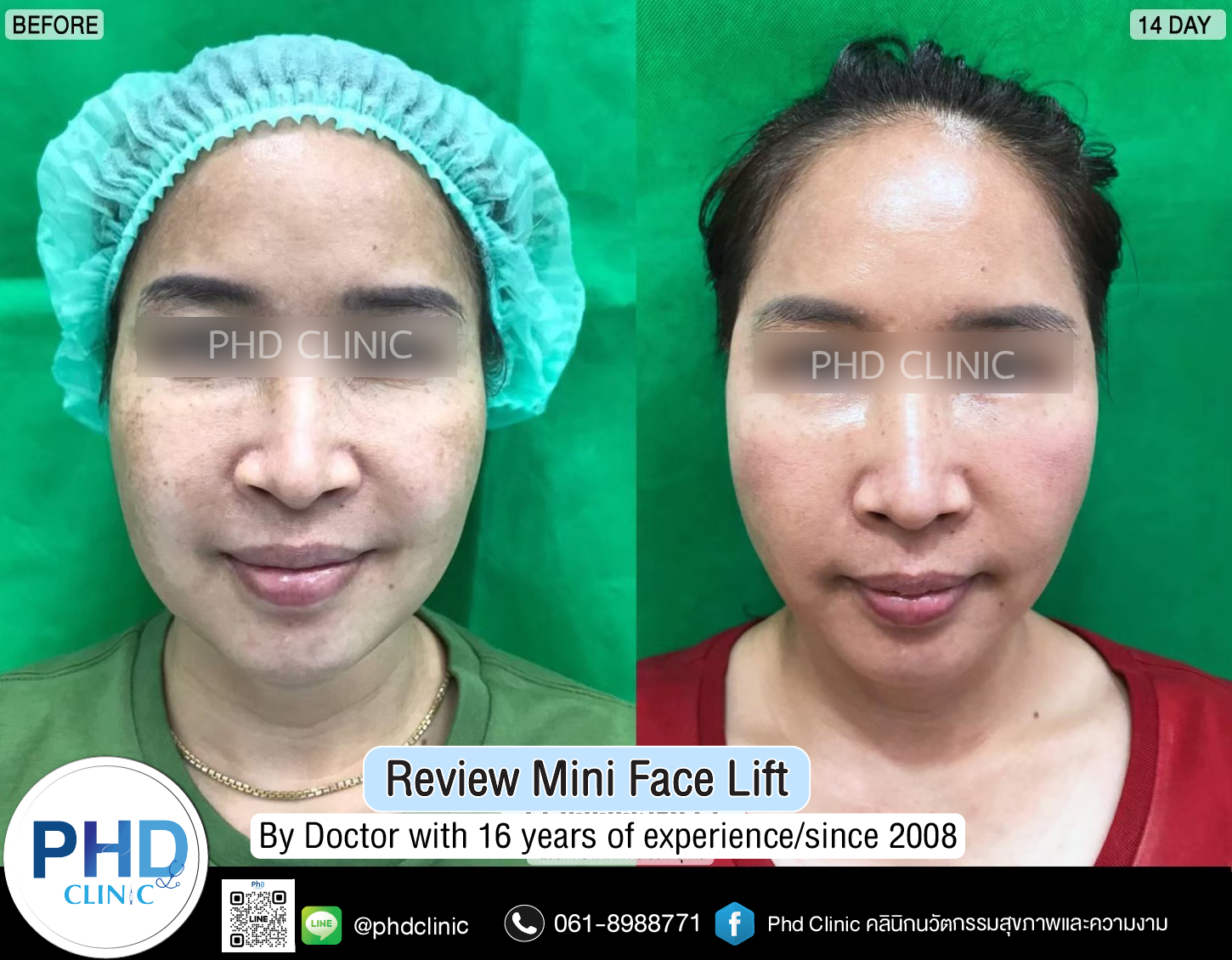 mini face lift