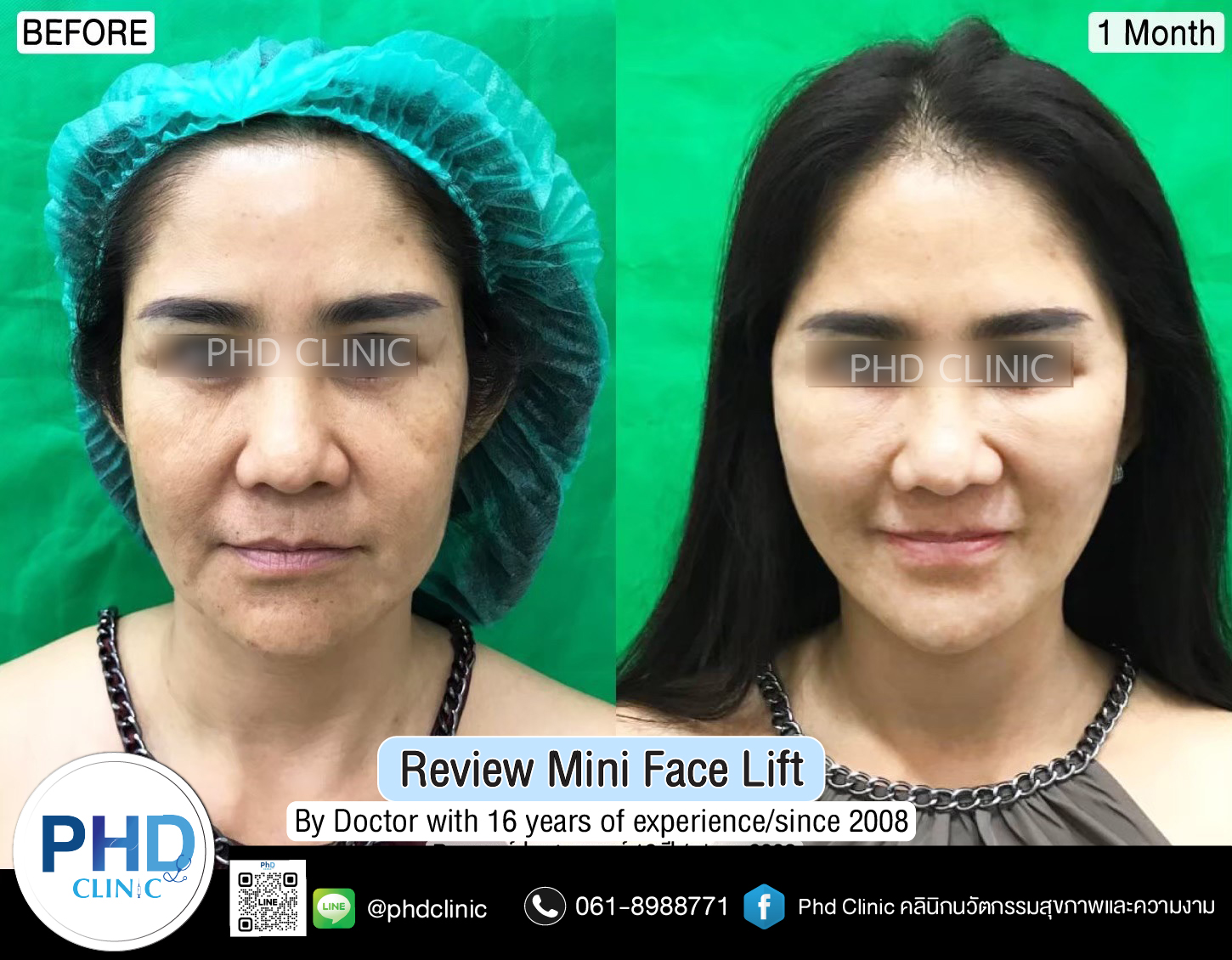 mini face lift