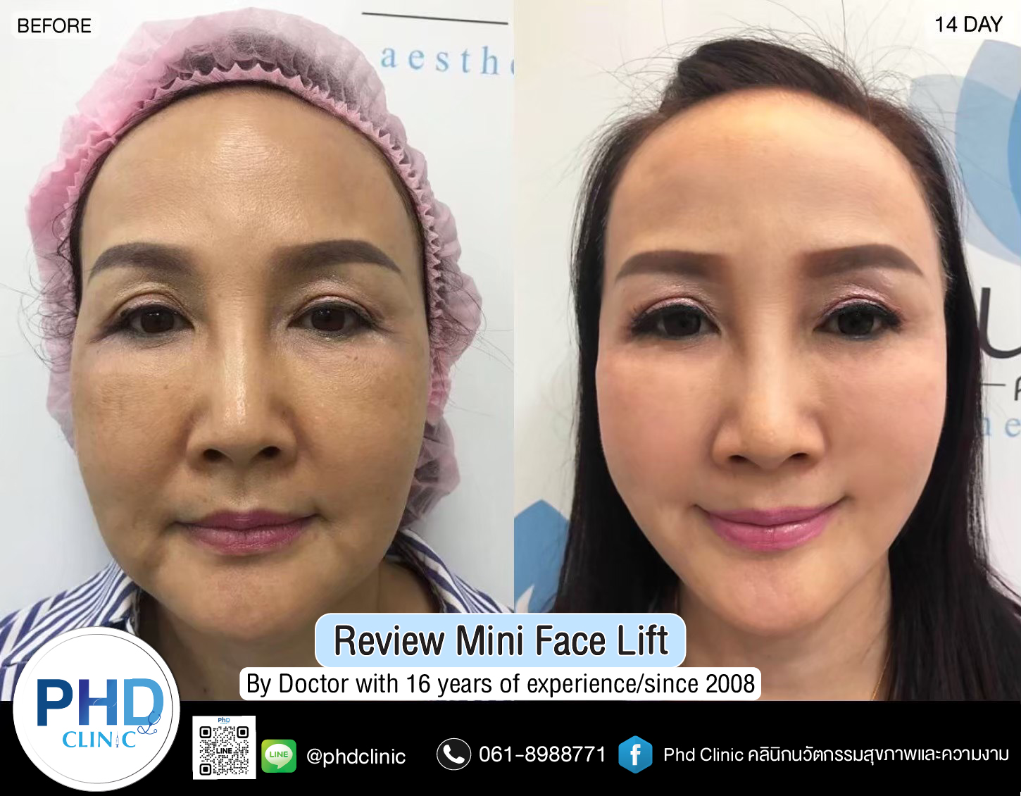 mini face lift