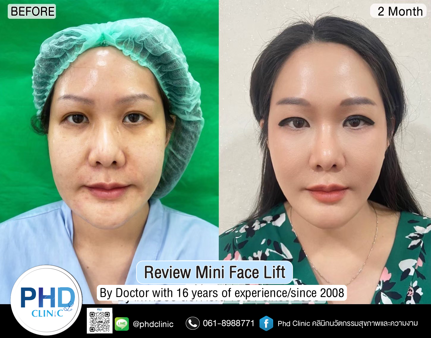 mini face lift