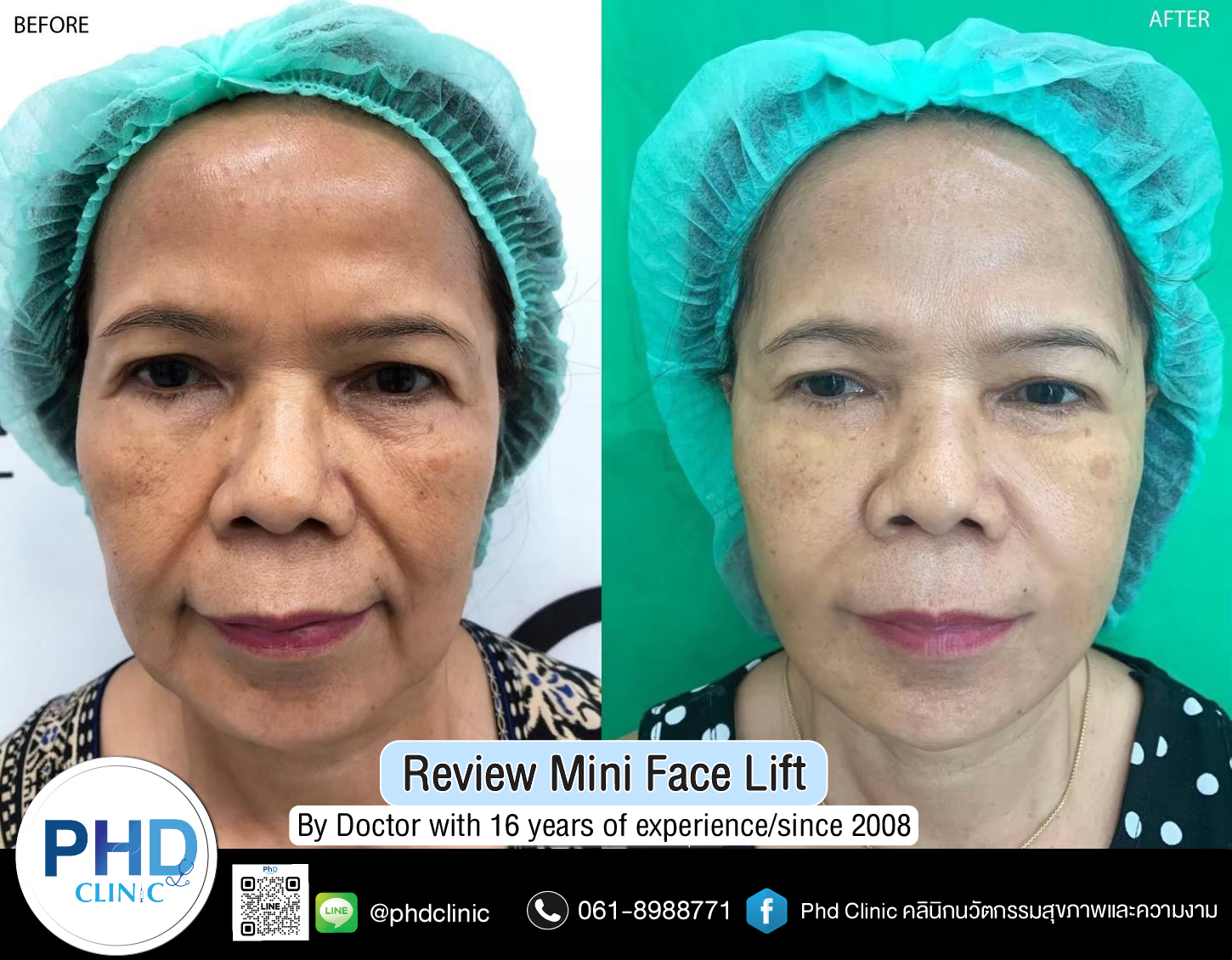 mini face lift