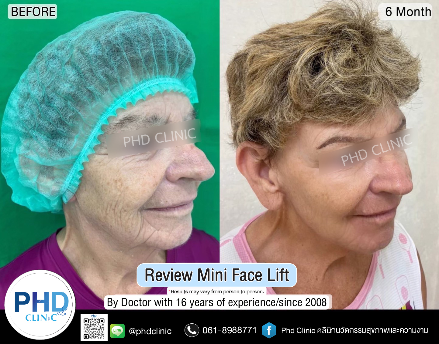 mini face lift