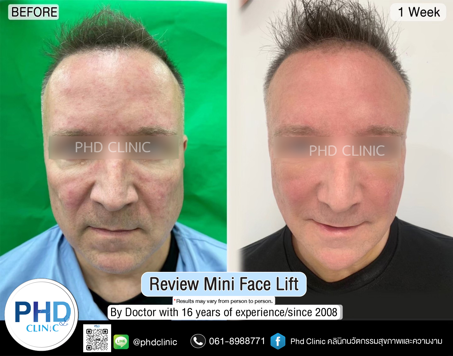 mini face lift