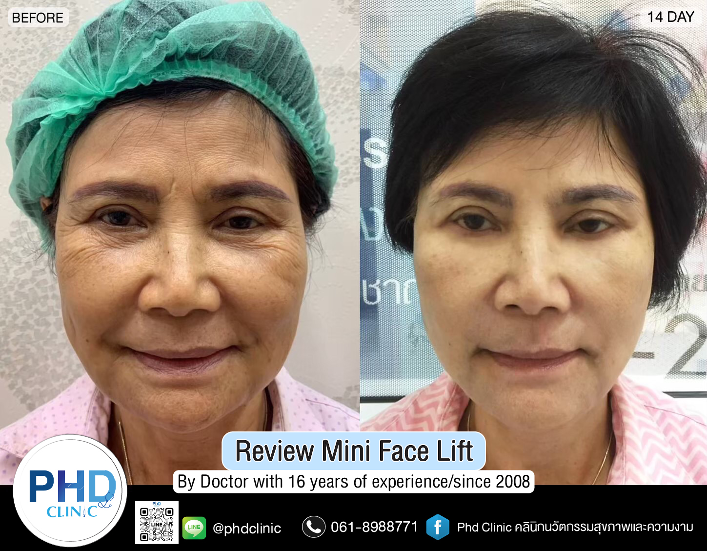 mini face lift