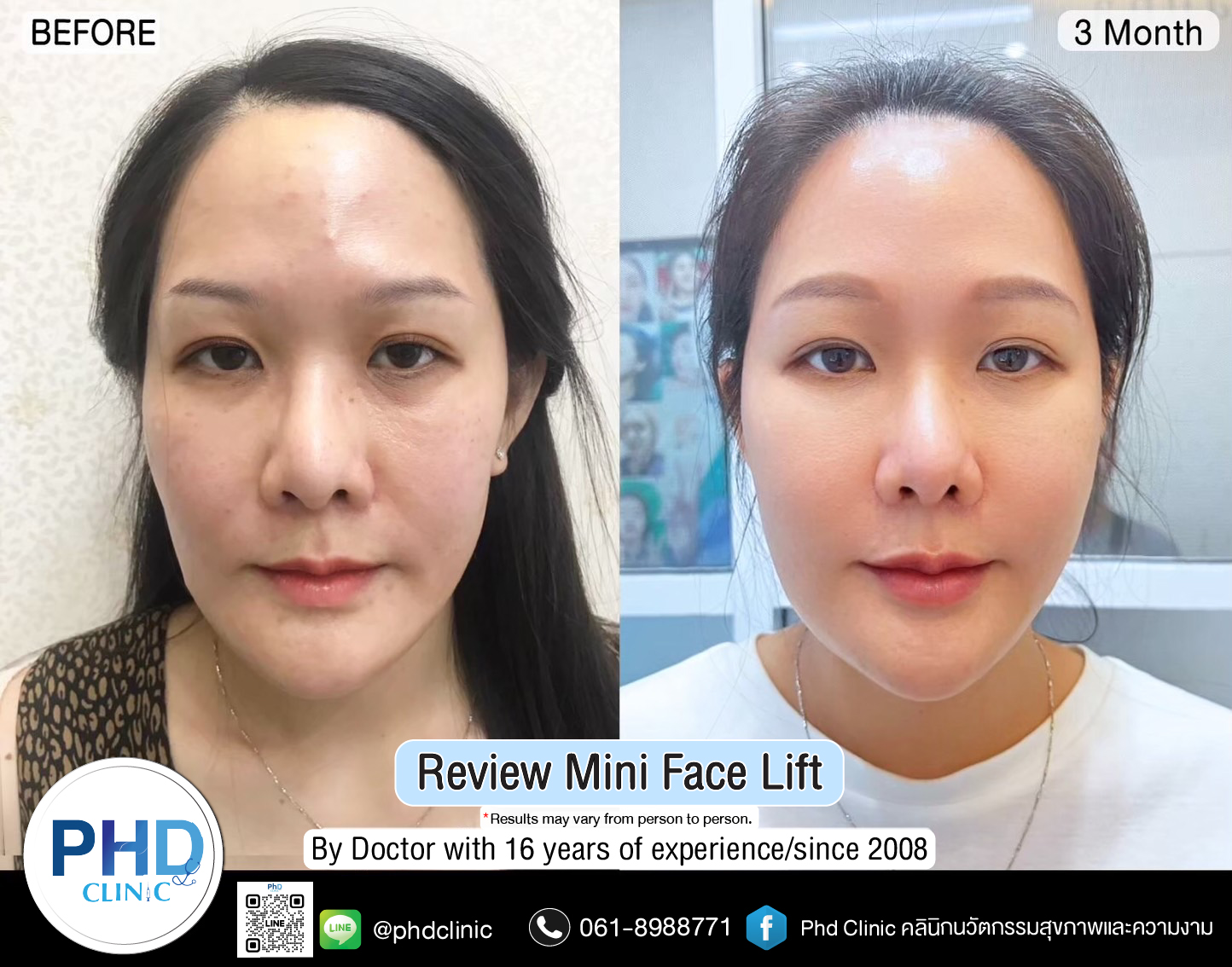 mini face lift