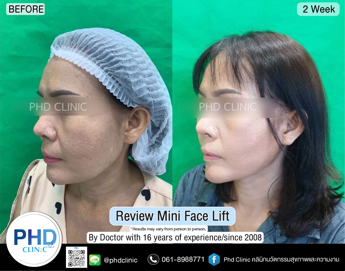 mini face lift