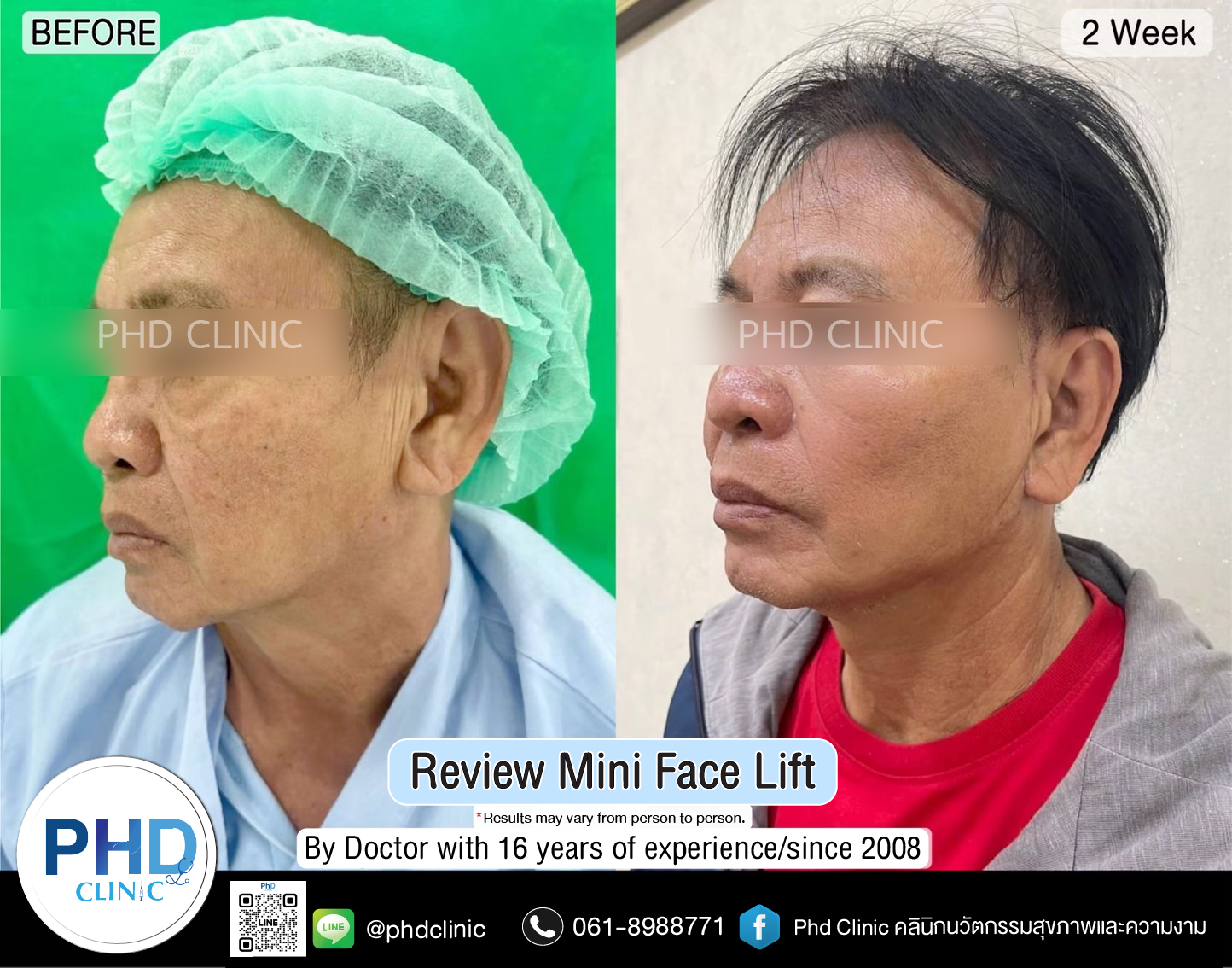 mini face lift