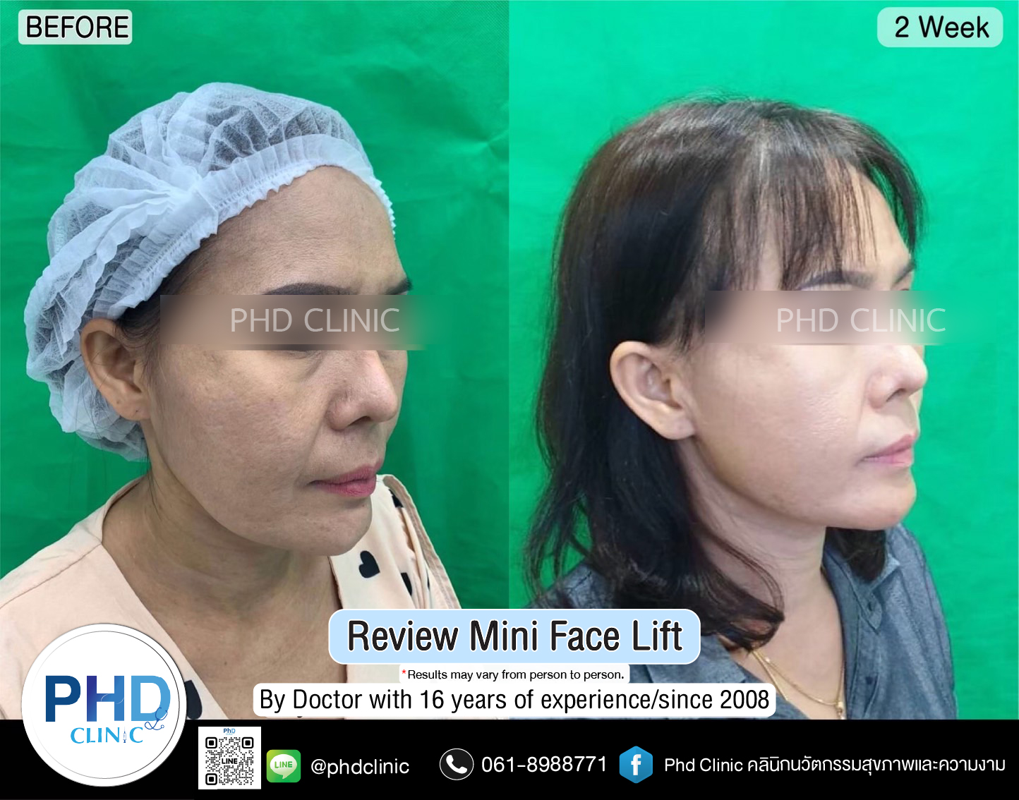 mini face lift