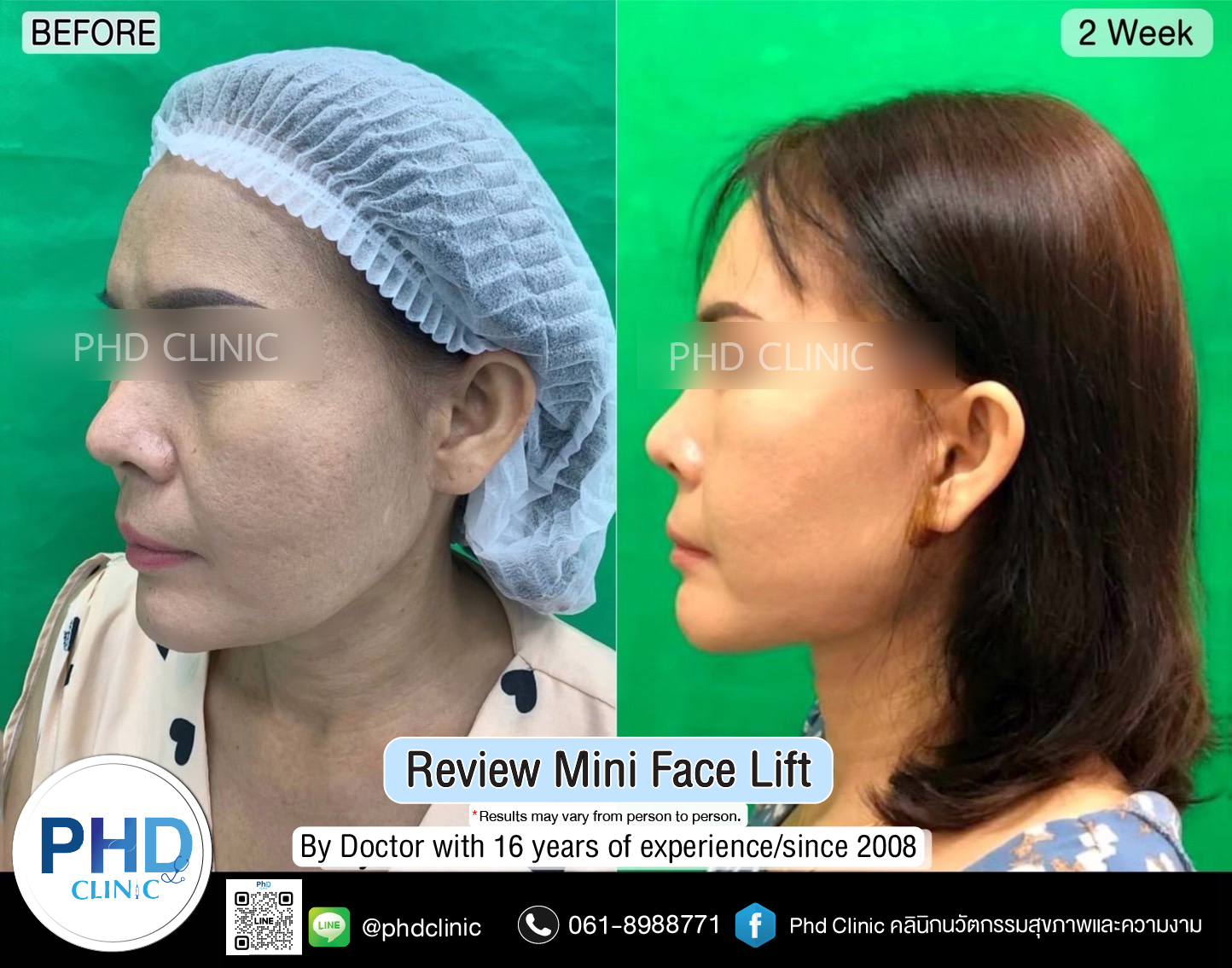 mini face lift