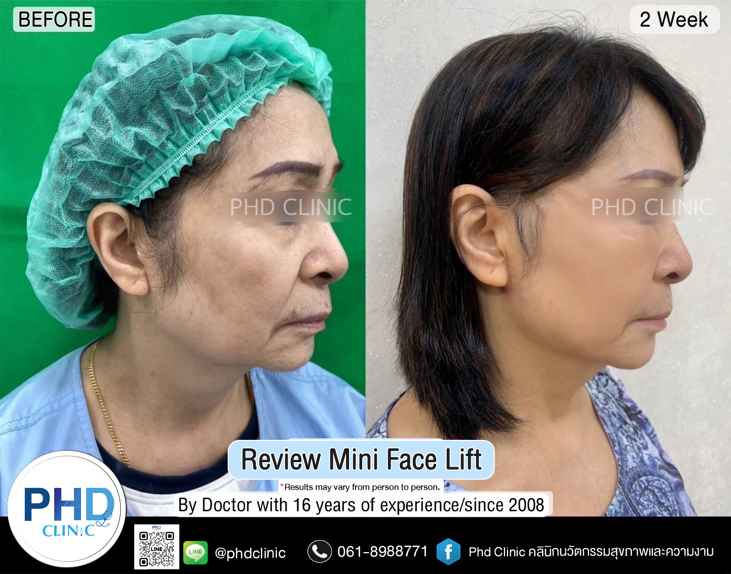 https://www.phd-clinic.com/mini-face-lift-surgery-pattaya/