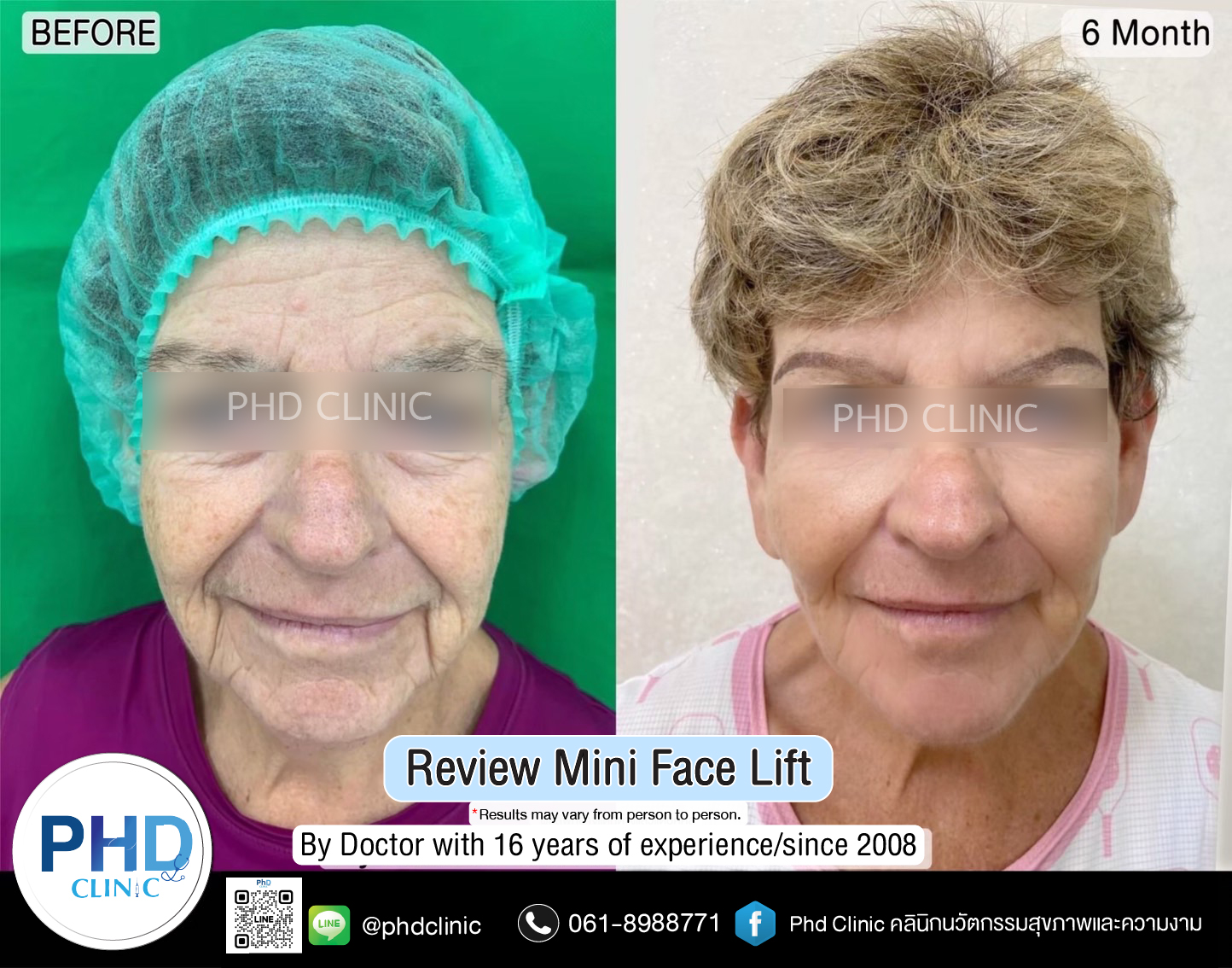 mini face lift