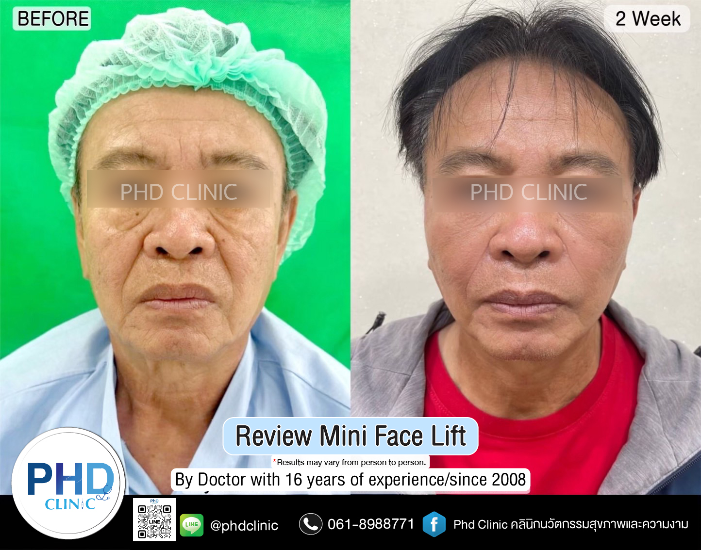 mini face lift