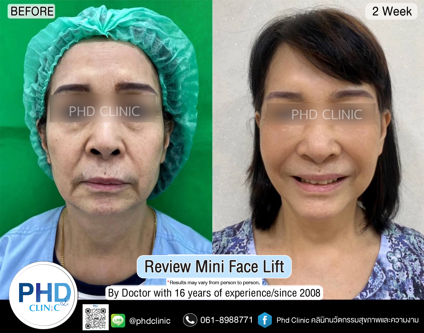 mini face lift